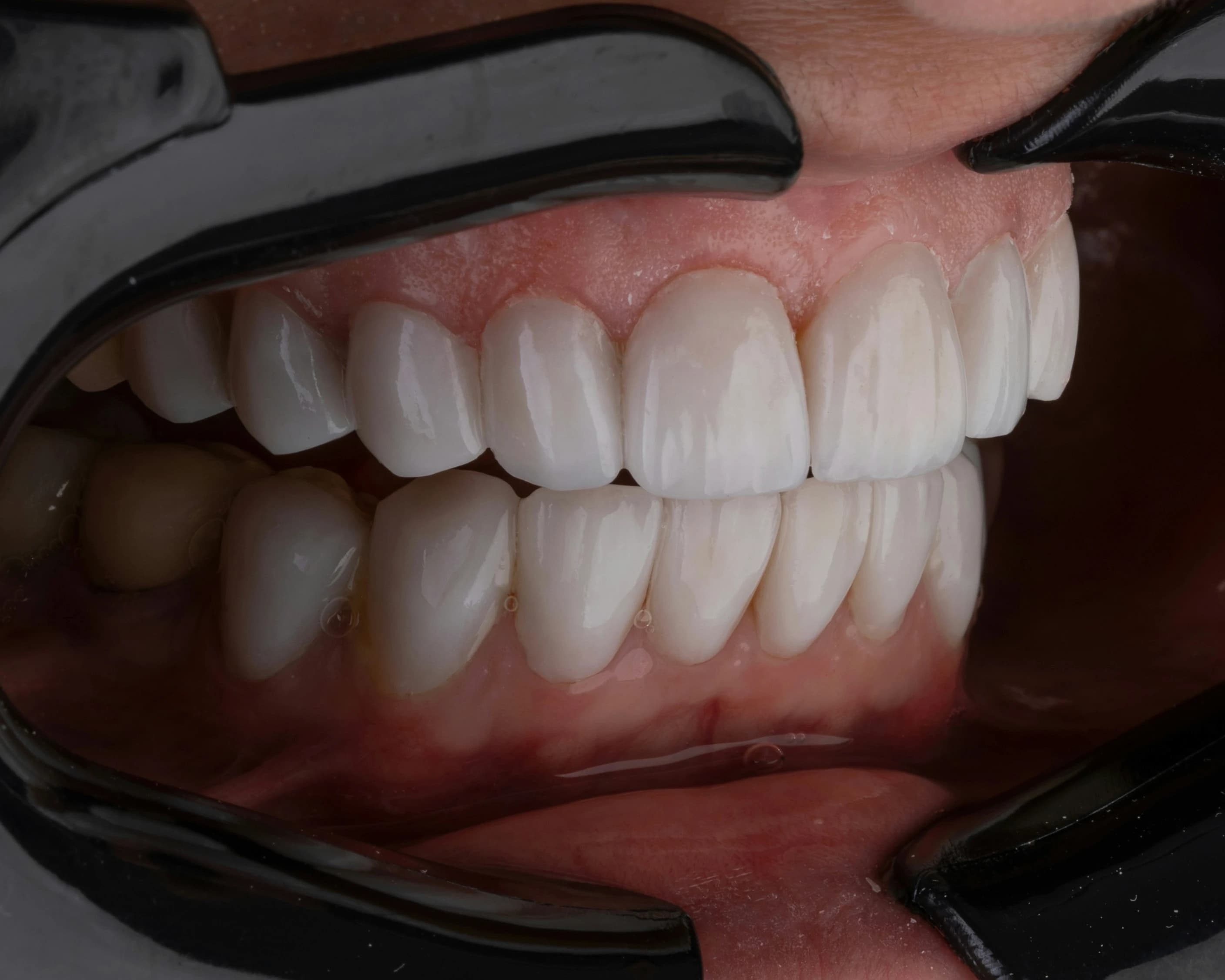 Bright smile after a whitening treatment