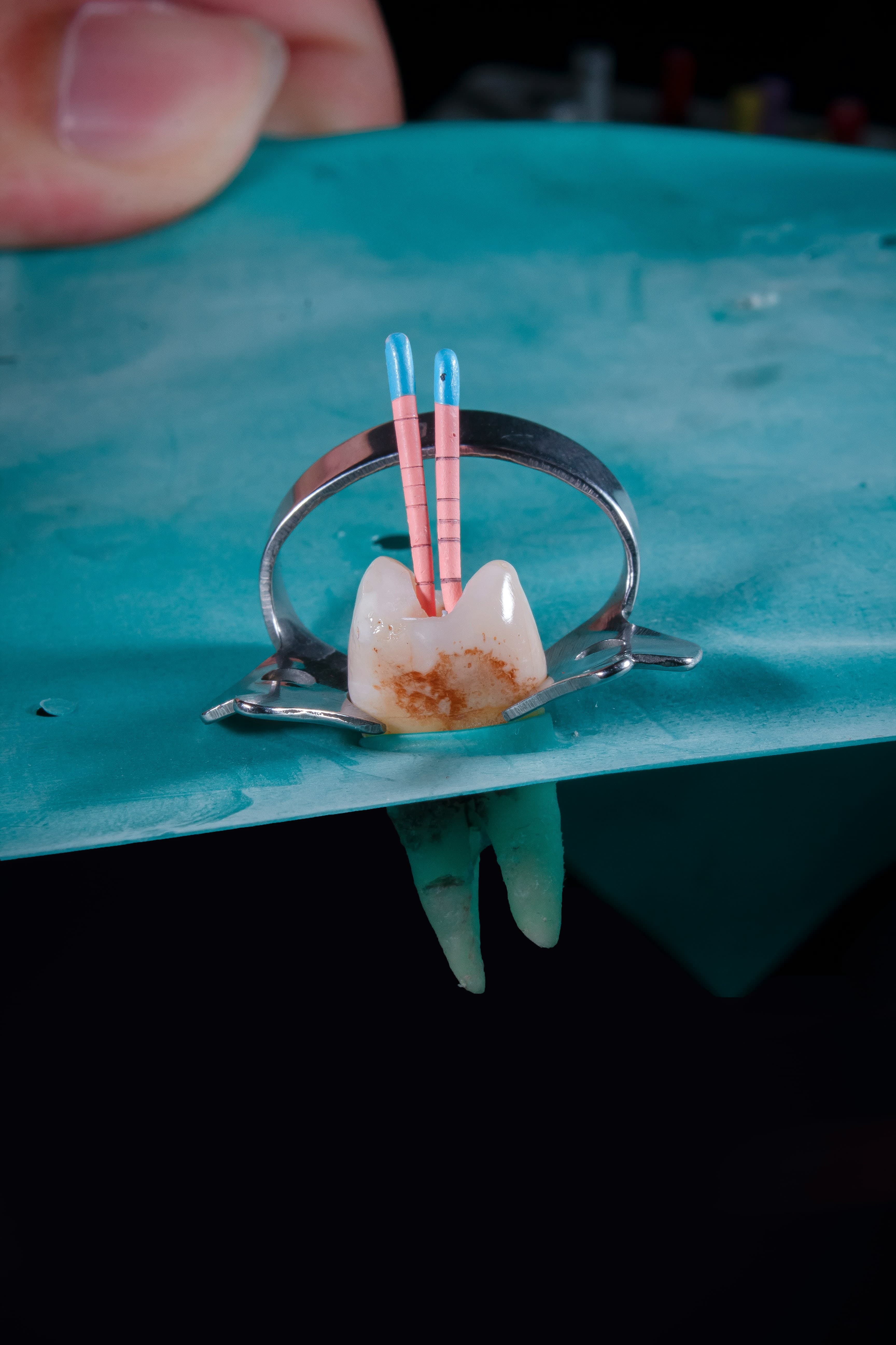 Dentist performing a root canal procedure