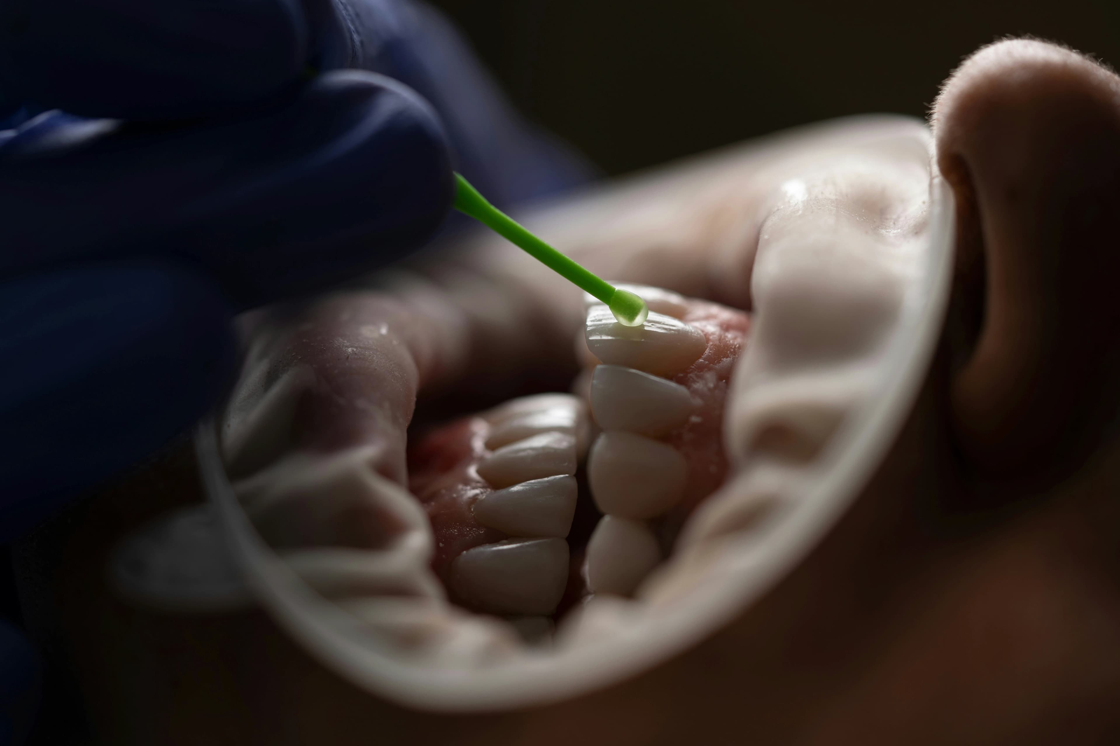Hygienist applying a professional cleaning treatment
